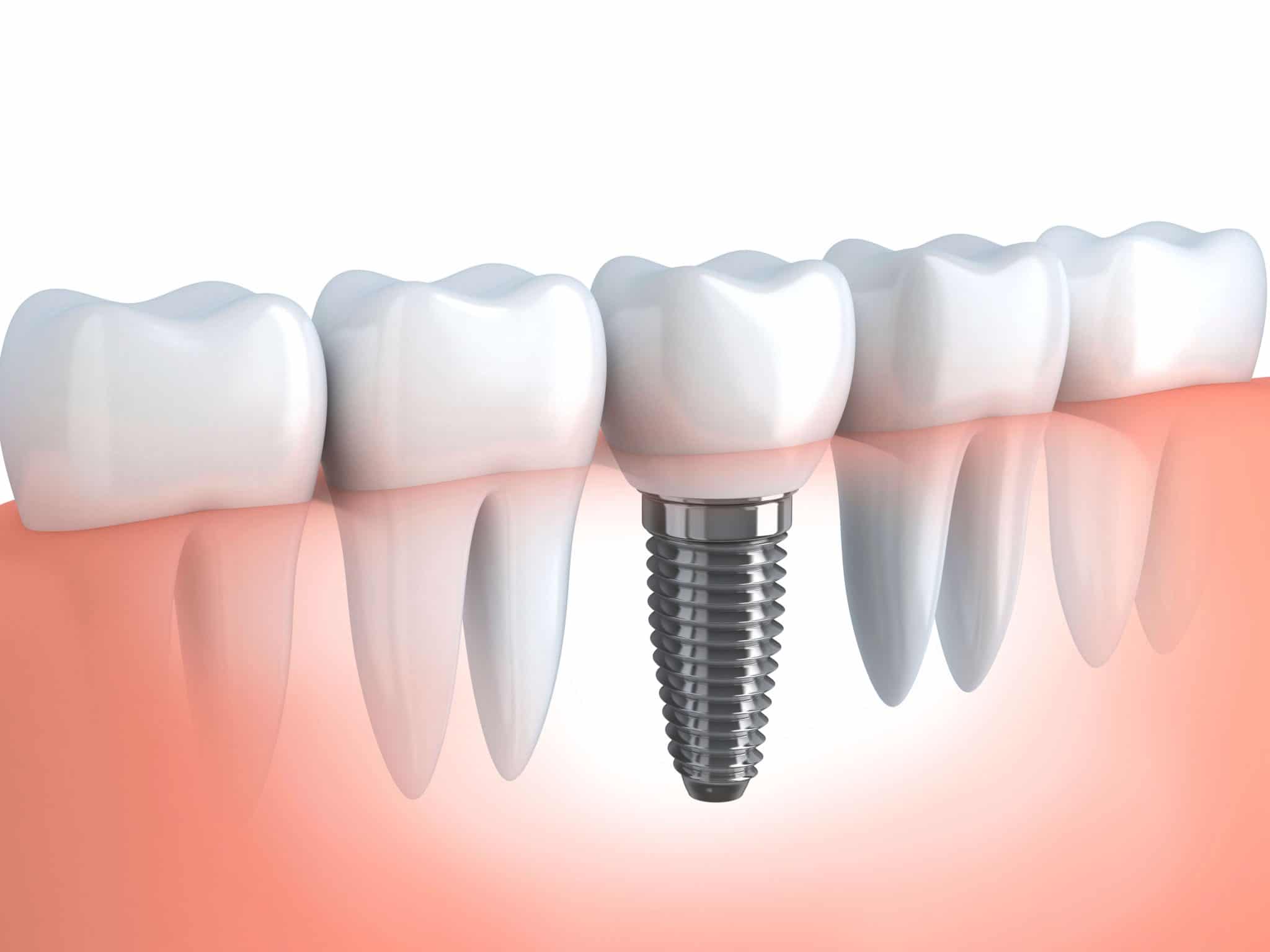Implant dentaire : que faut-il savoir ?